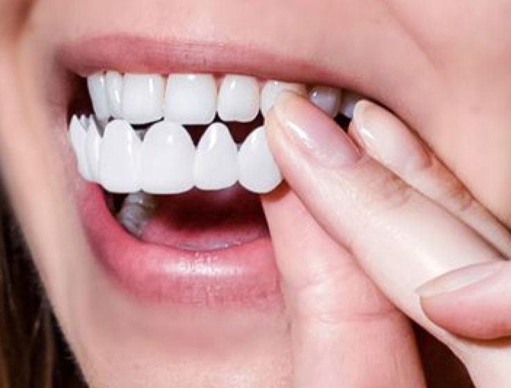 Snap On Teeth Veneers